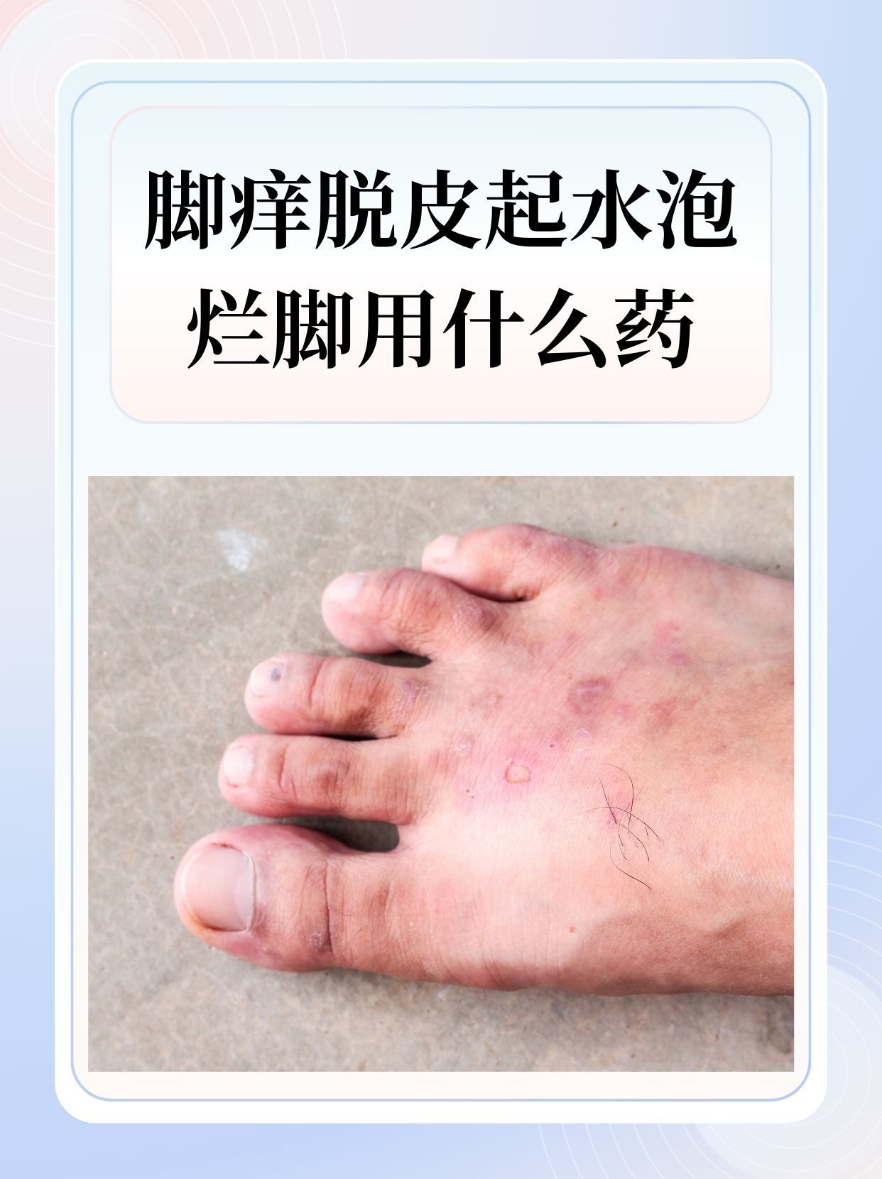 脚痒脱皮起水泡烂脚用什么药 在日常生活中,脚部健康问题常常困扰着