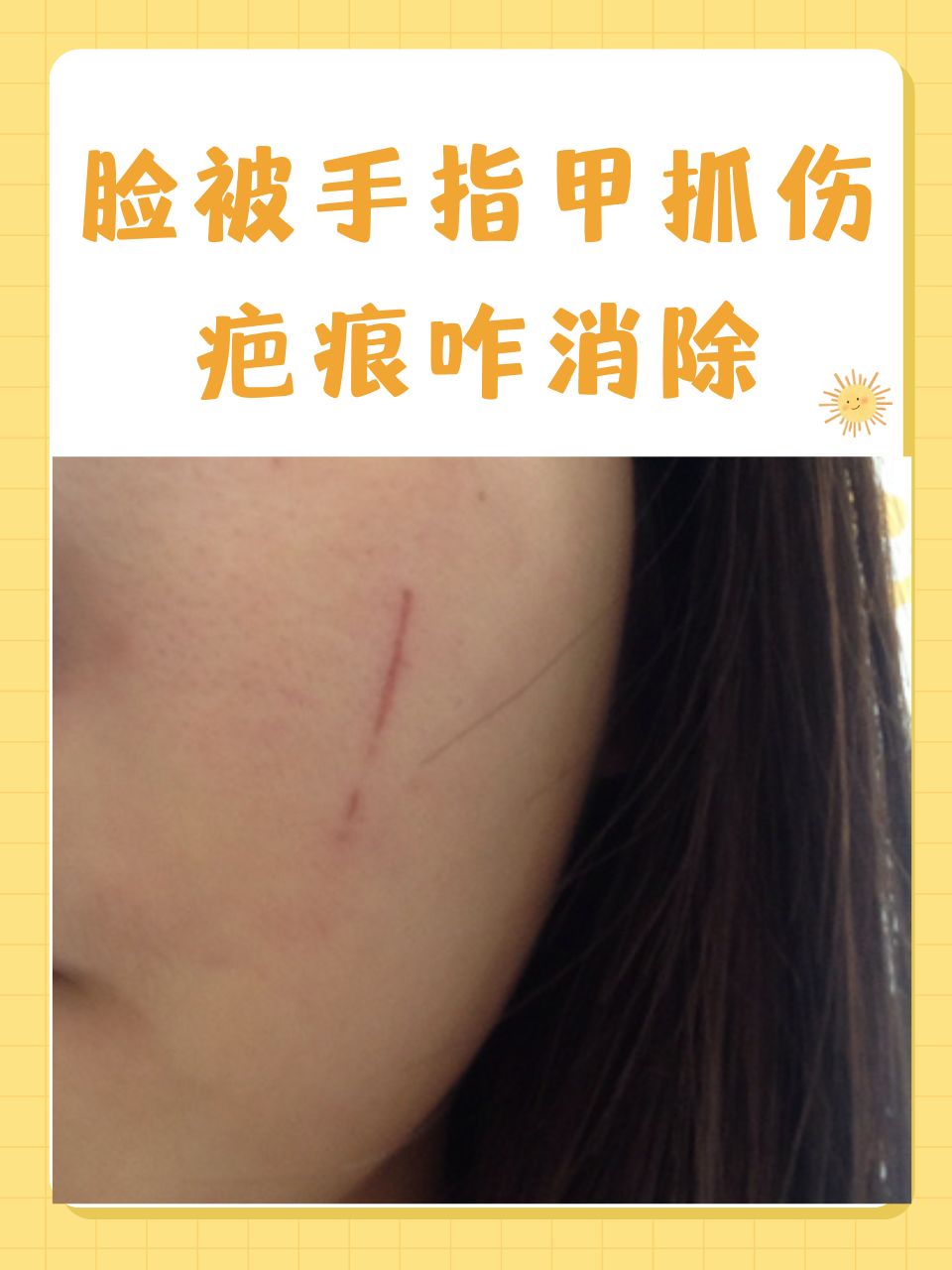 脸被手指甲抓伤疤痕咋消除 一不小心被手指甲抓伤,留下的疤痕不仅影响