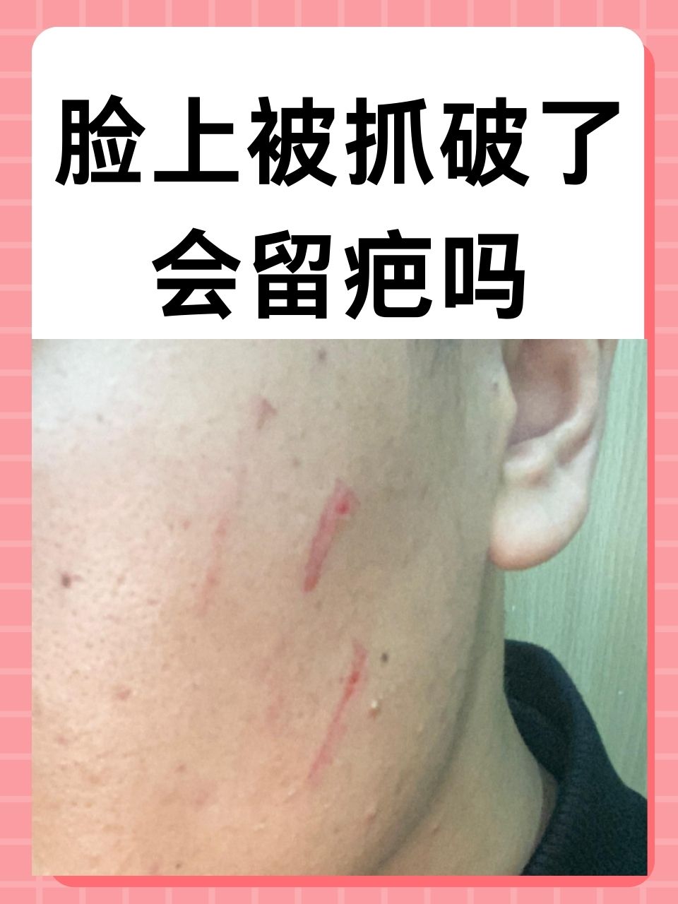 脸上被抓破了会留疤吗 在日常生活的琐碎与不经意间,我们或许都曾遭遇