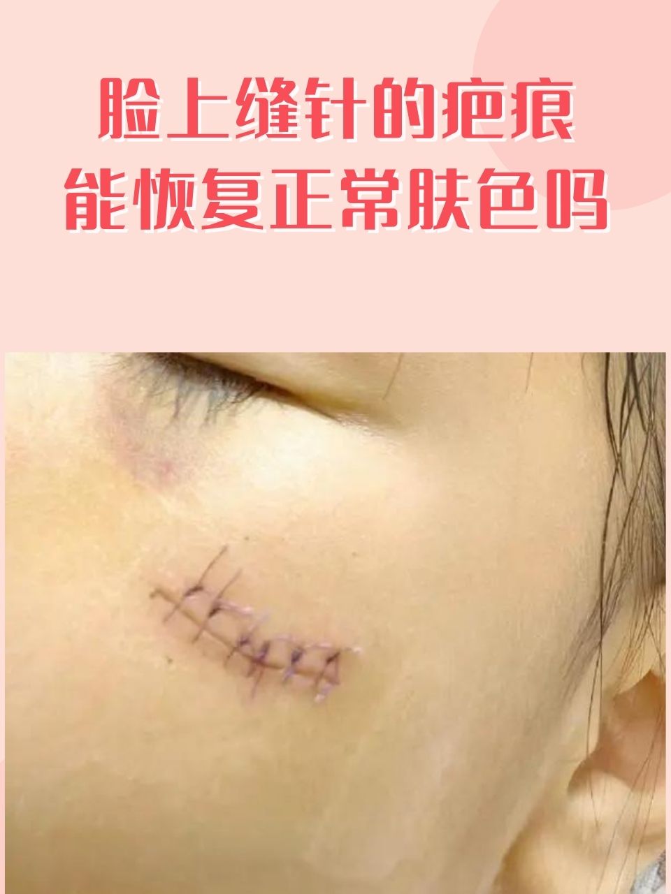 那么,脸上缝针的疤痕到底能不能恢复正常肤色呢?