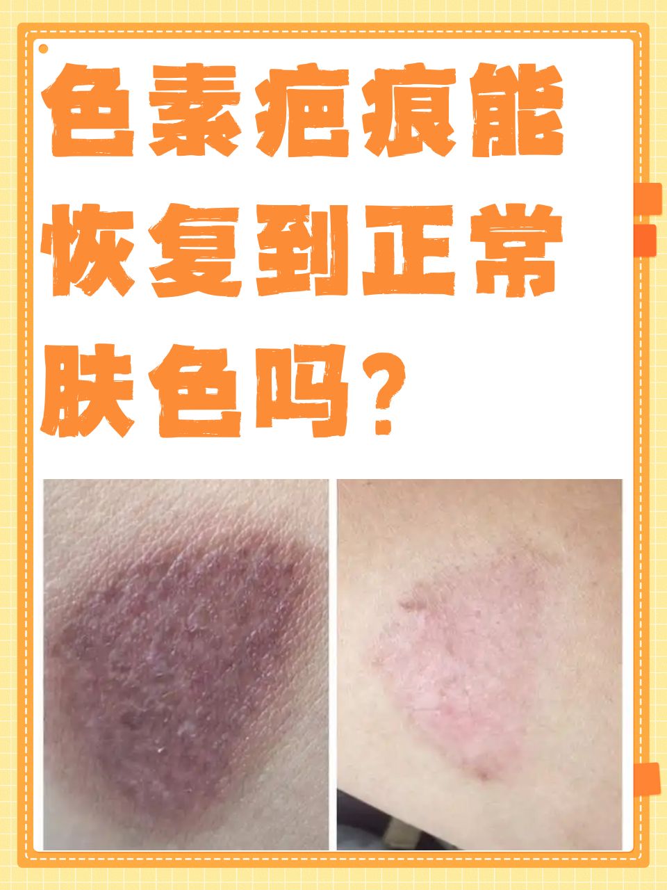 色素疤痕是许多人面临的困扰,它不仅影响美观,还可能给患者带来心理