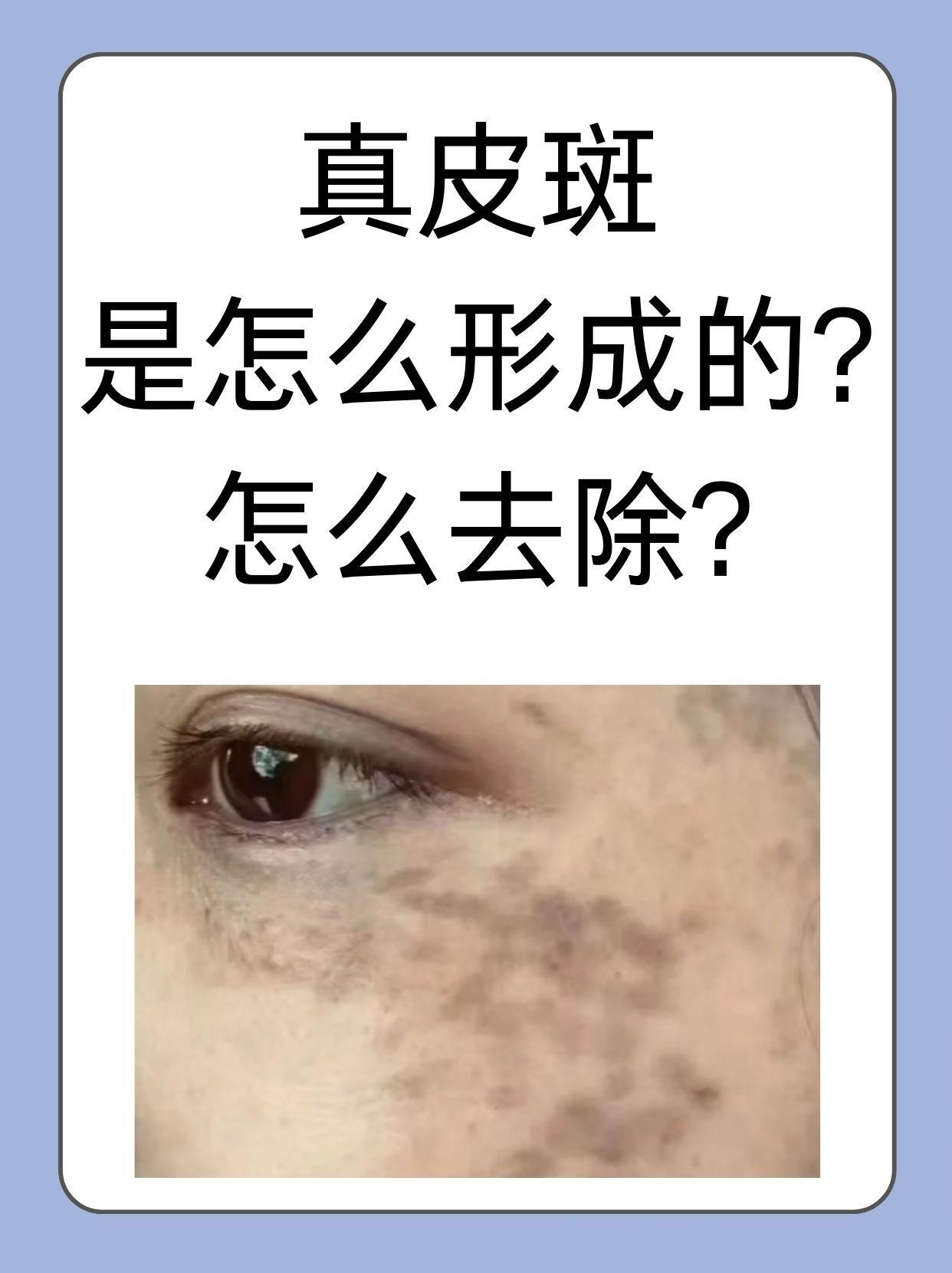 其中真皮斑是一种较为顽固的色斑类型很多人对它并不了解