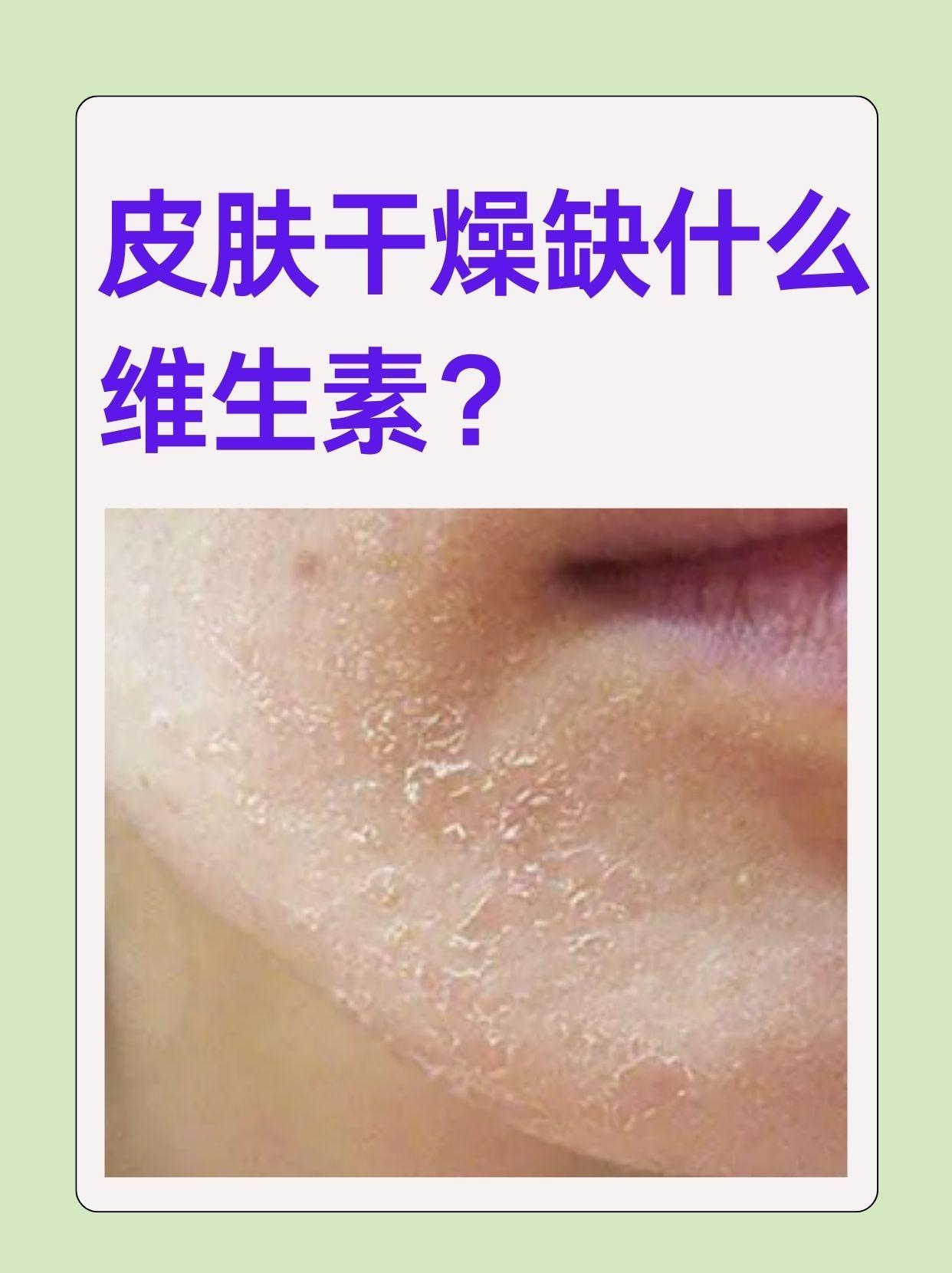 皮肤科医生来科普皮肤干燥是缺什么维生素呢?