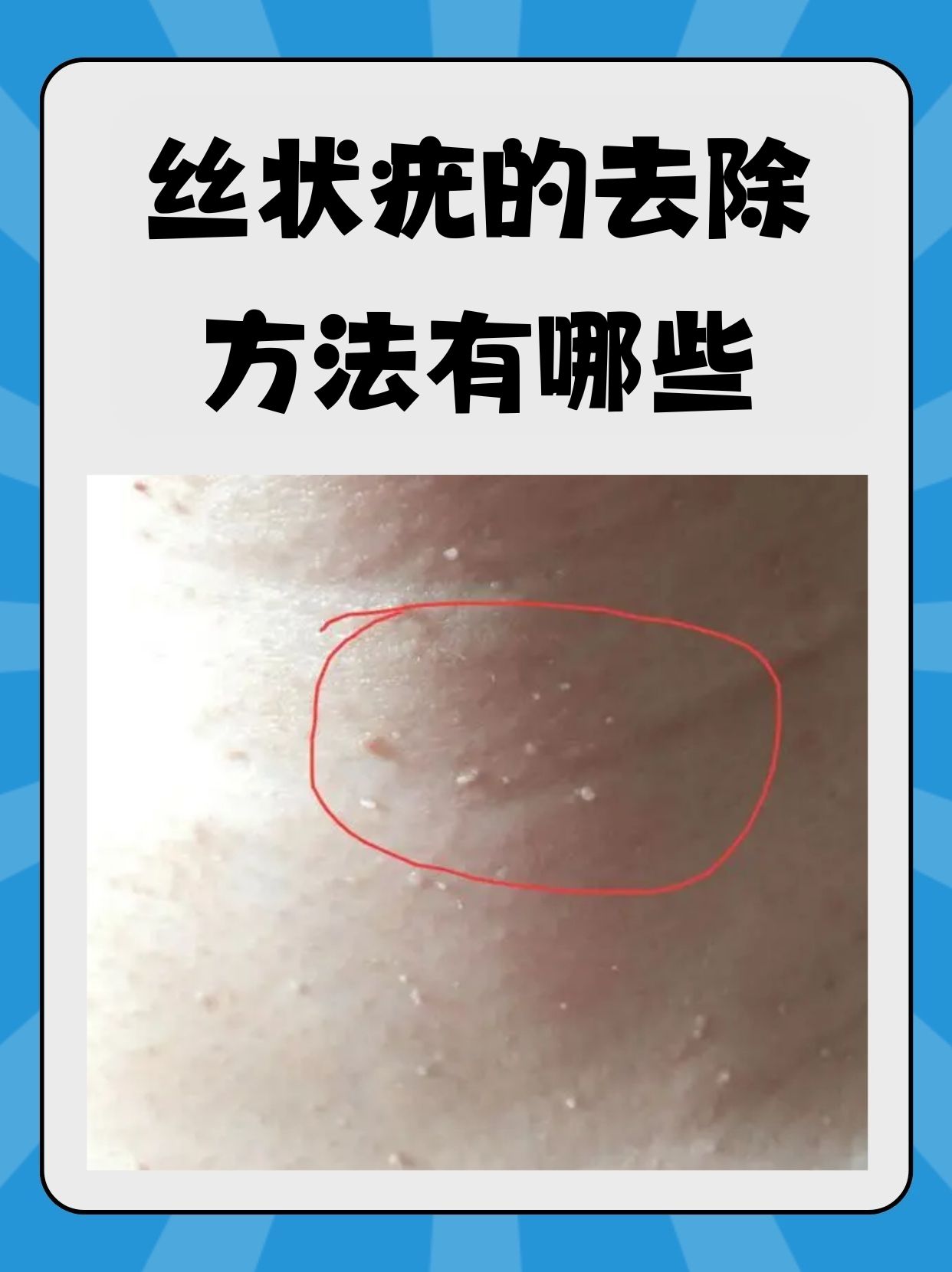 丝状疣的去除方法有哪些?