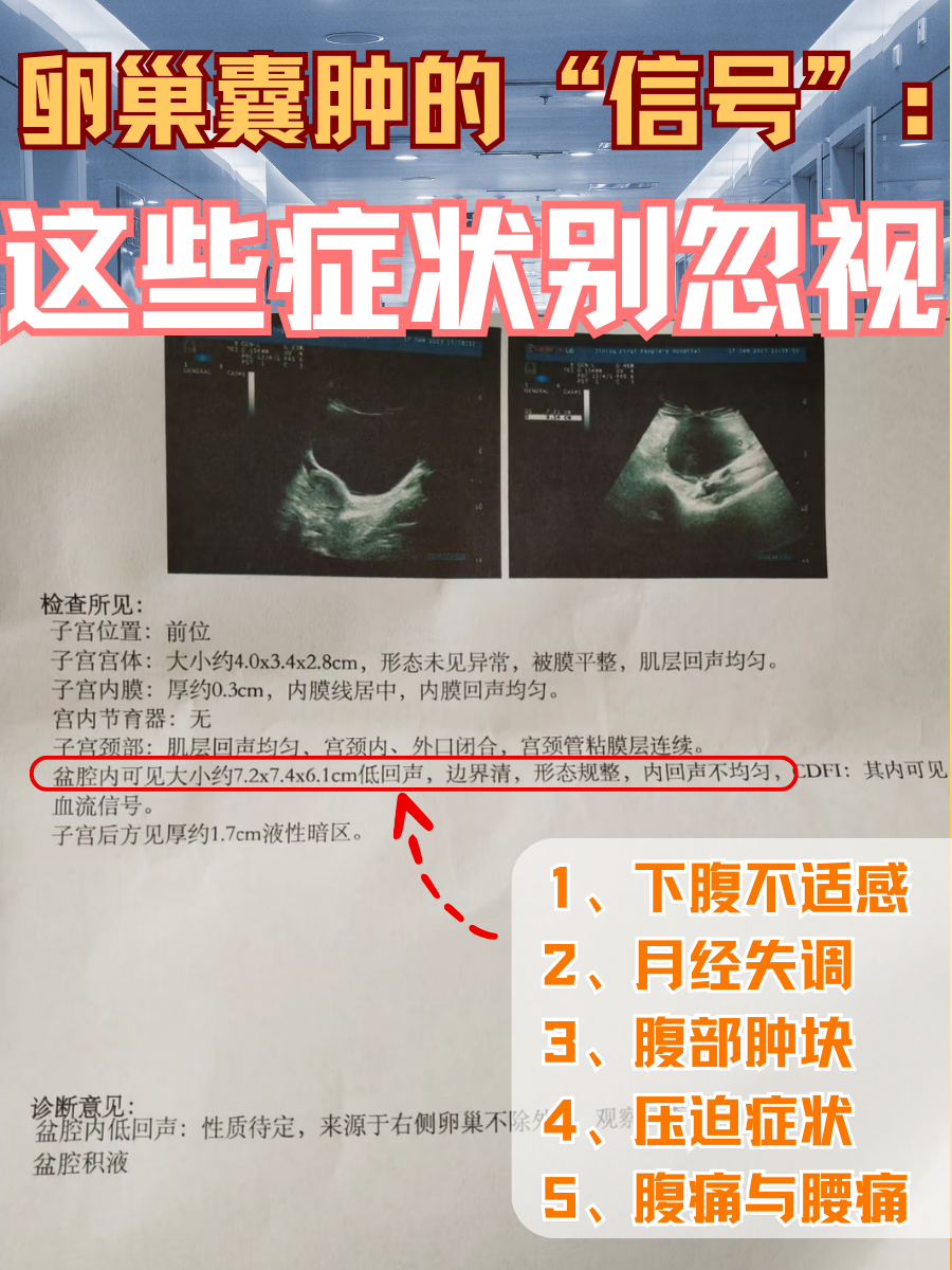 卵巢囊肿的"信号":这些症状别忽视