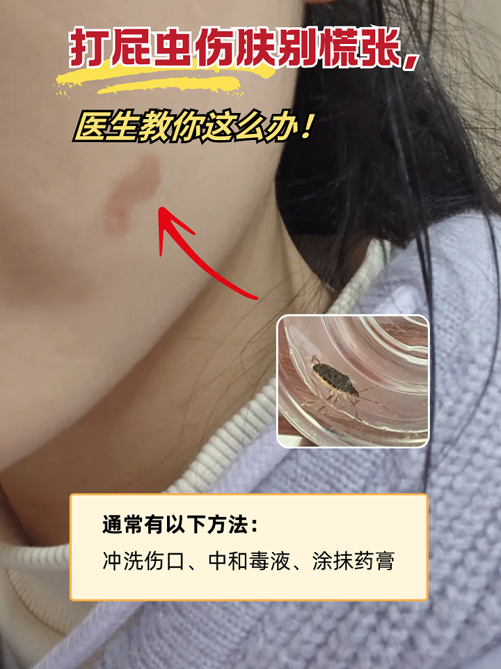 打屁虫伤肤别慌张,医生教你这么办!