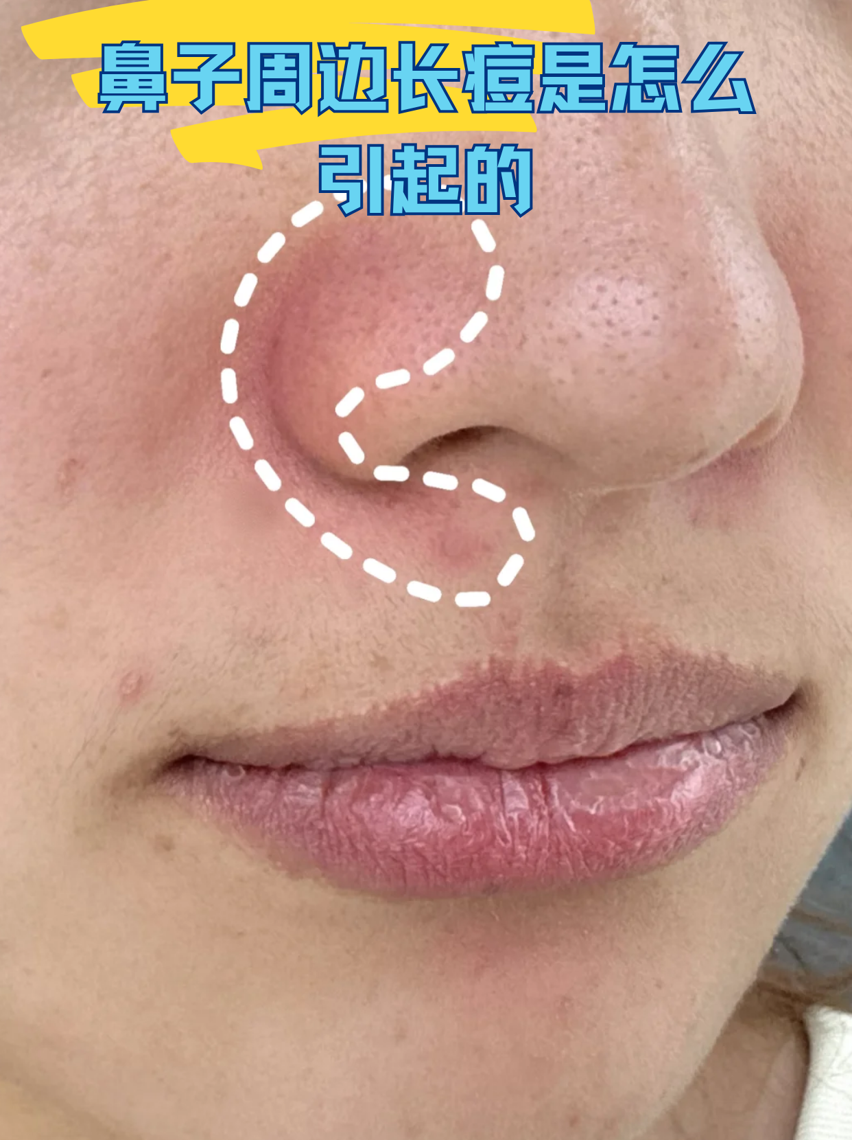 鼻子周边长痘是怎么引起的