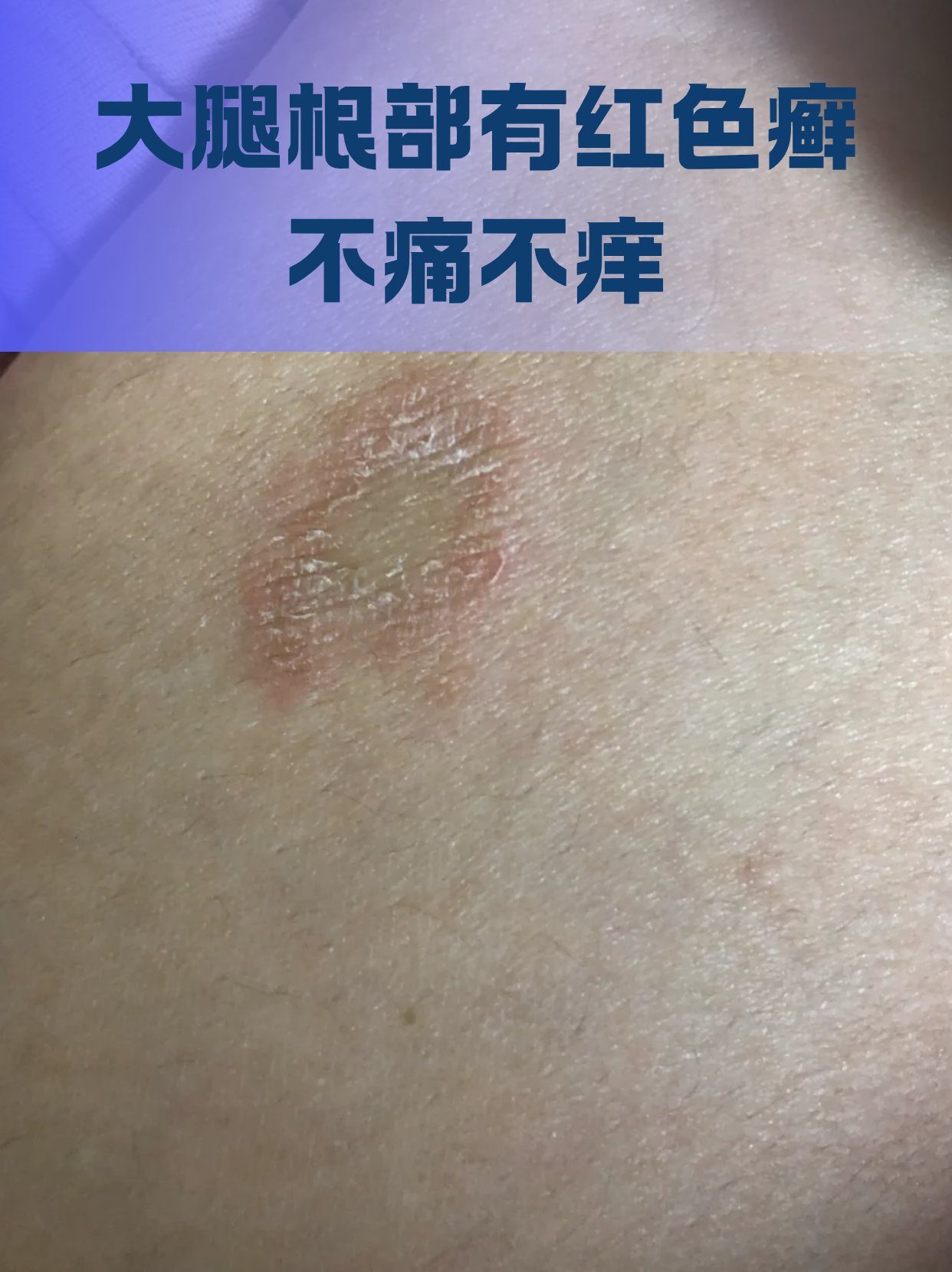 大腿根部有红色癣不痛不痒