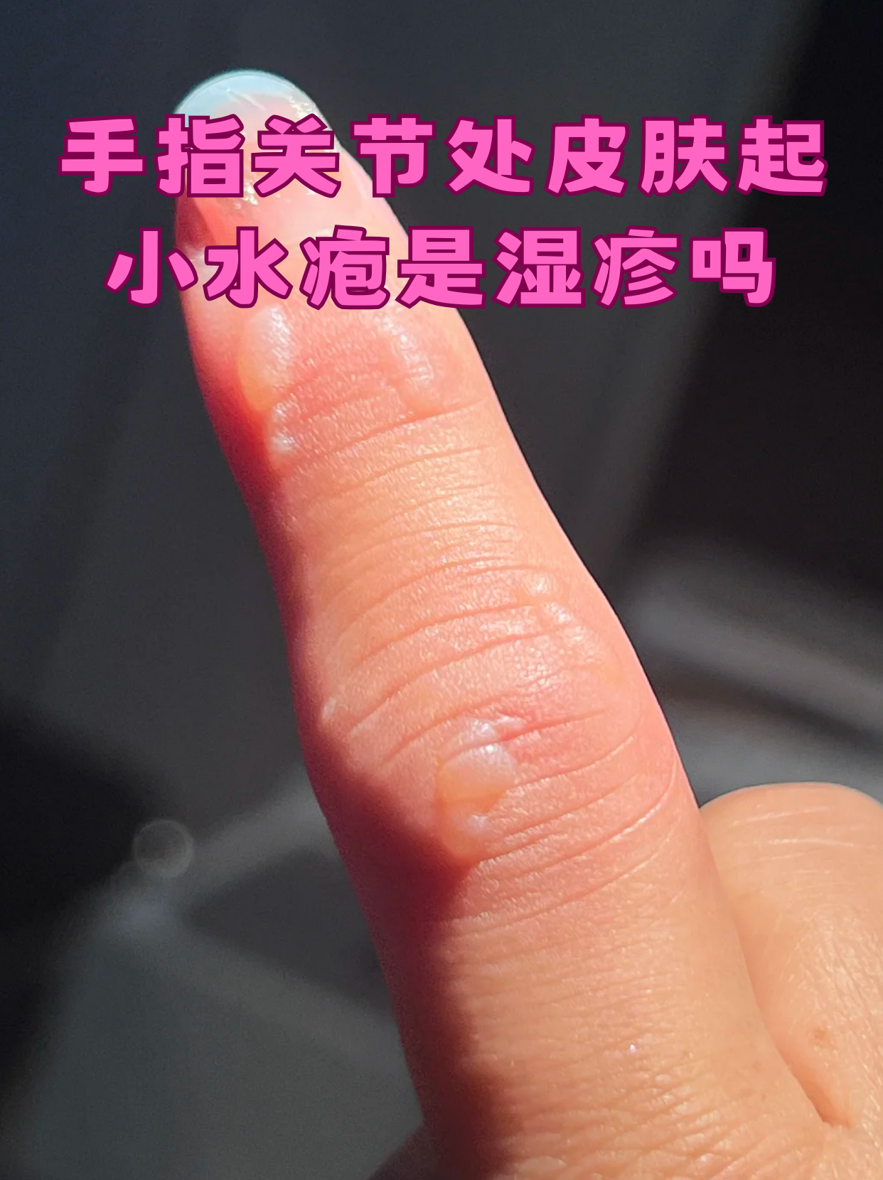 手指关节处皮肤起小水疱是湿疹吗