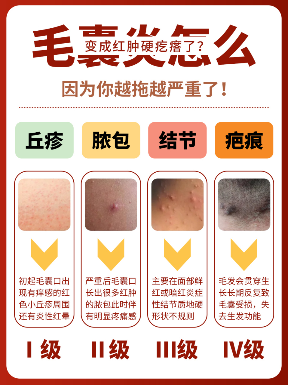 毛囊炎怎么变成红肿硬疙瘩啦71因为你没及时干预75  #毛囊炎治疗