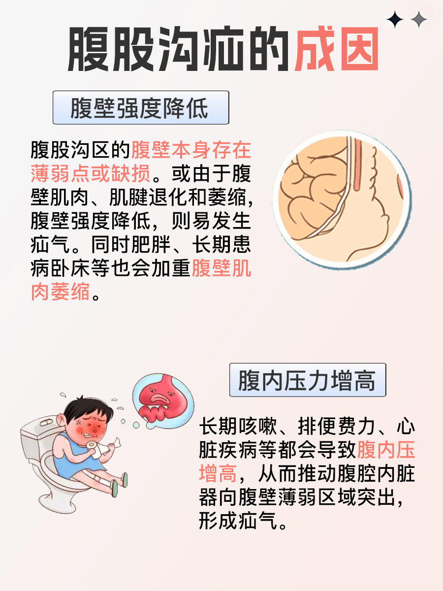 腹股沟疝,俗称"疝气",是一种常见的外科疾病,尤其在老年人和儿童中