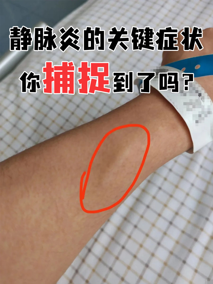 静脉炎,作为一种常见的血管炎症,主要表现为静脉壁的发炎,可能伴随