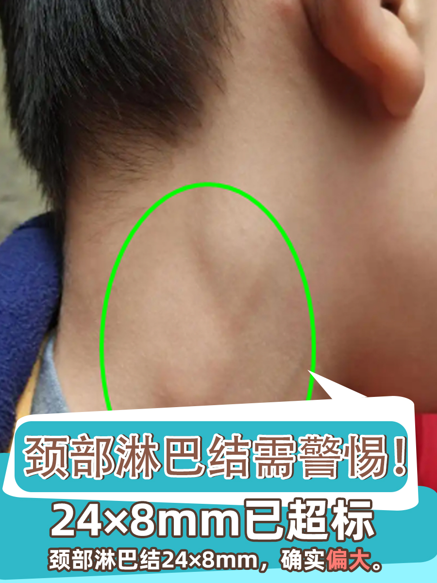 颈部淋巴结是人体淋巴系统的重要组成部分,位于颈部