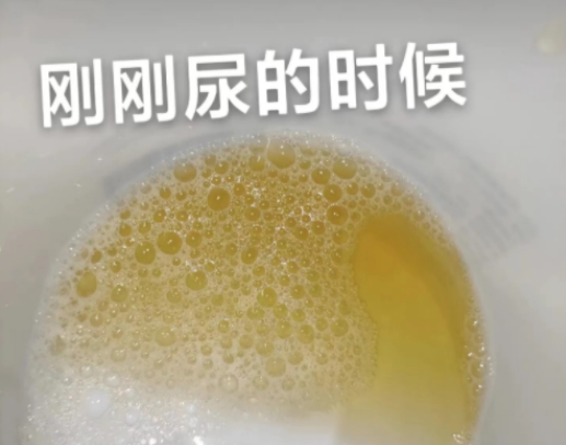 原发病未得到有效控制; 尿蛋白升高的根本原因往往与肾脏疾病有关