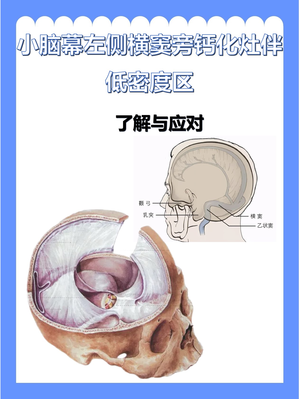 【小脑幕左侧横窦旁钙化灶伴低密度区:了解与应对】 在医学影像检查中