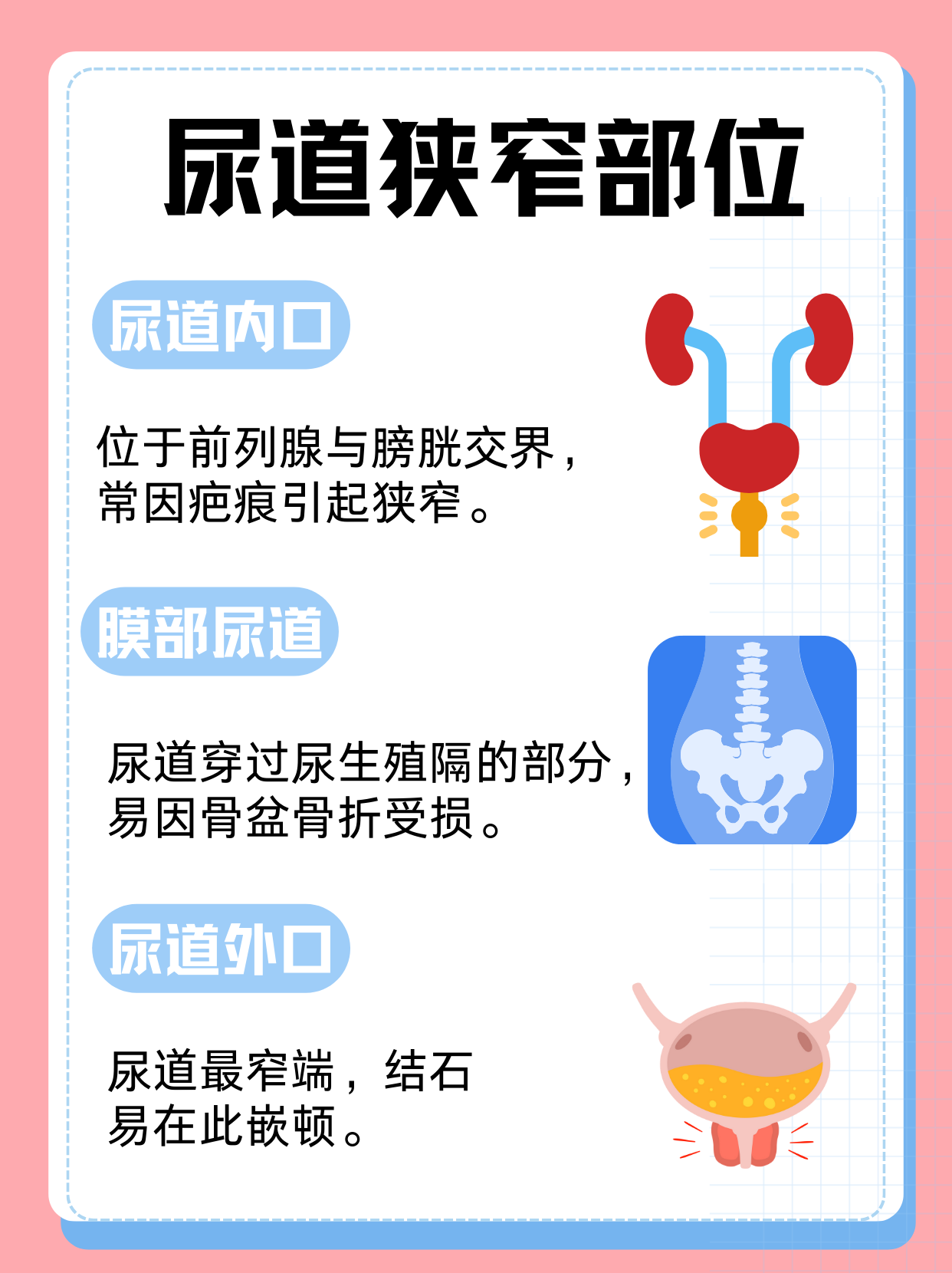 道狭窄的三个关键部位",希望能帮助大家更好地了解这一常见泌尿系统