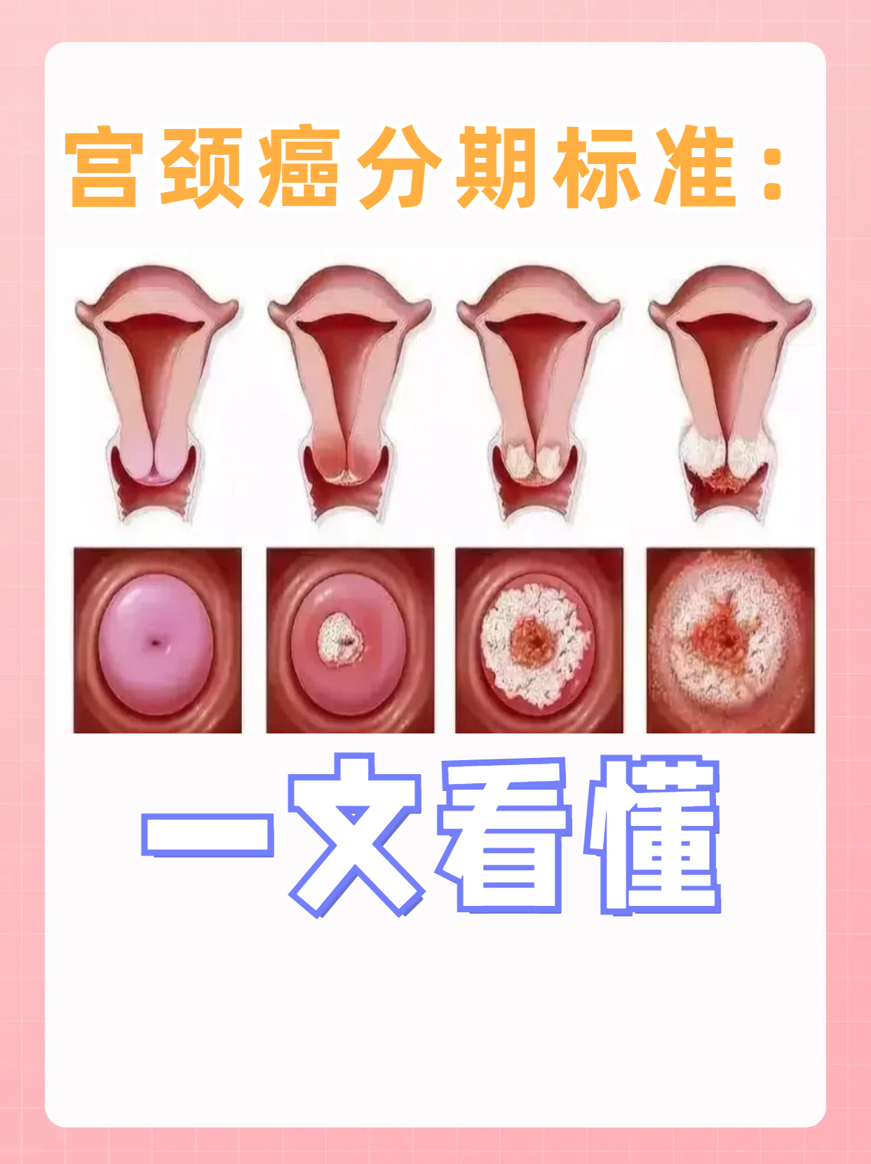 宫颈癌分期标准:一文看懂 宫颈癌的分期主要依据肿瘤的大小,扩散程度