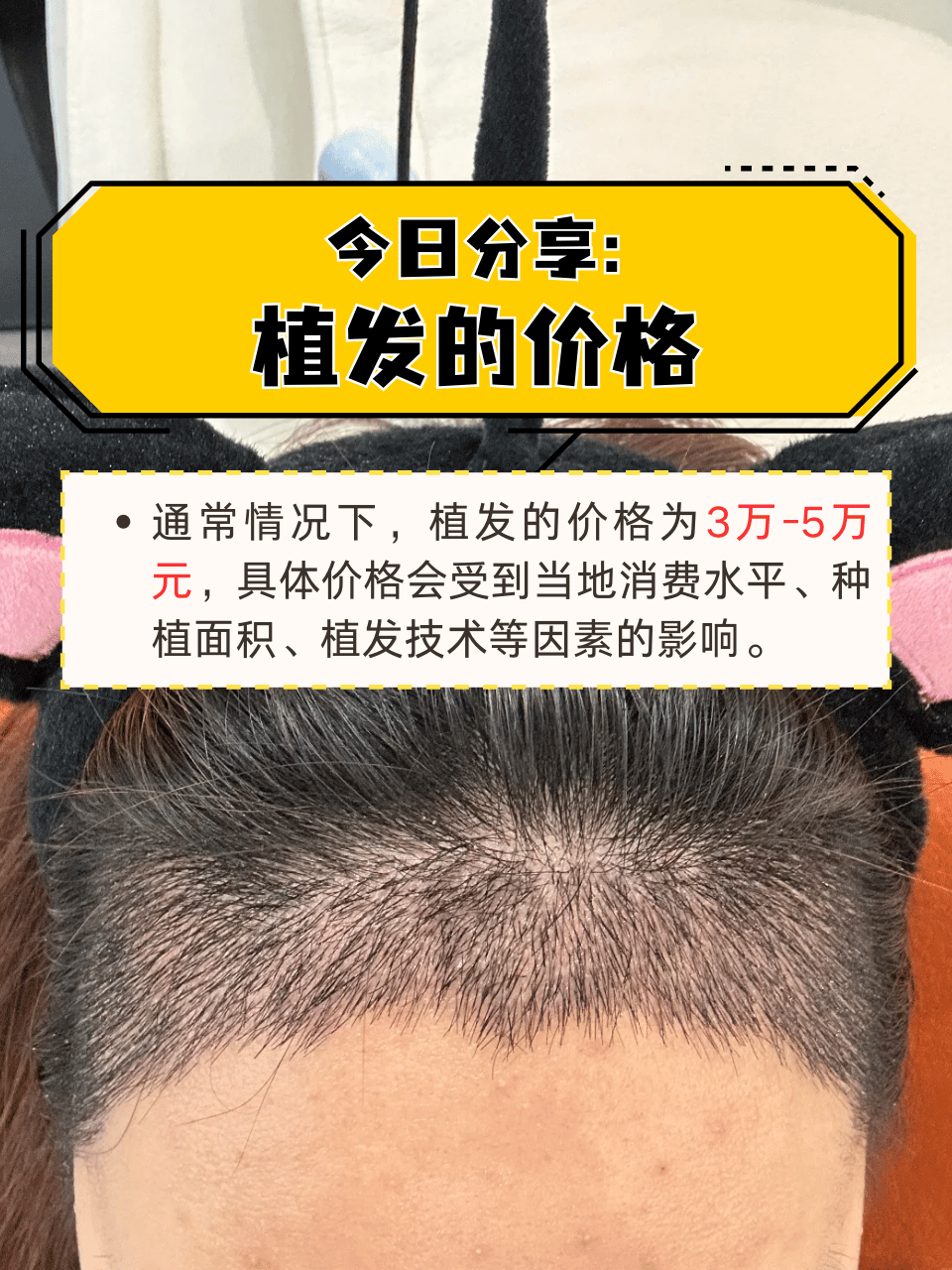 植发是一种治疗脱发的手段,主要是通过毛发移植