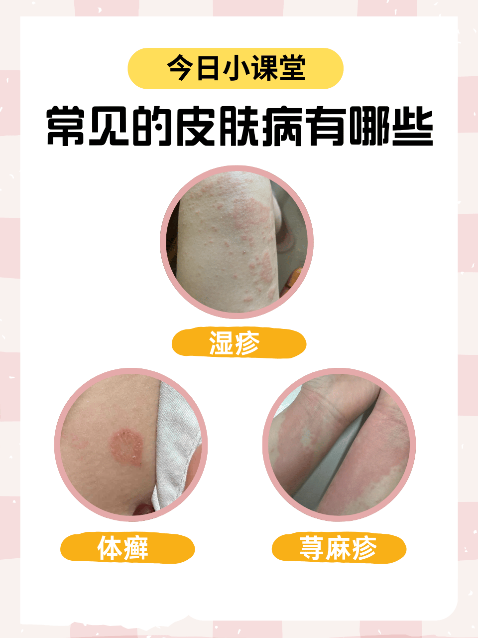 身上为什么会起湿疹 身上为什么会起湿疹