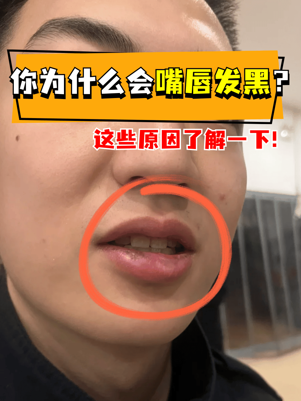 下嘴唇正常的黑斑图片嘴唇上长黑斑是什么原因嘴唇黑色素沉淀图片唇炎