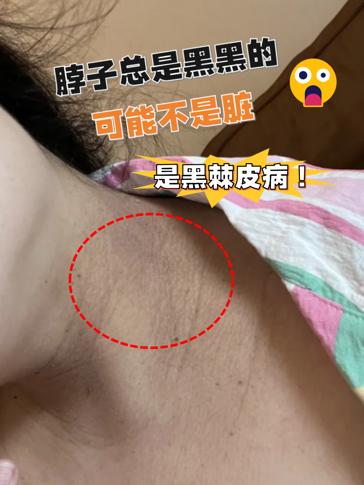 脖子总是黑黑的,可能不是脏,是黑棘皮病!