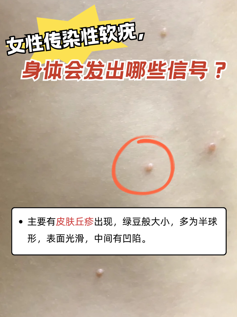 女性传染性软疣,身体会发出哪些信号?