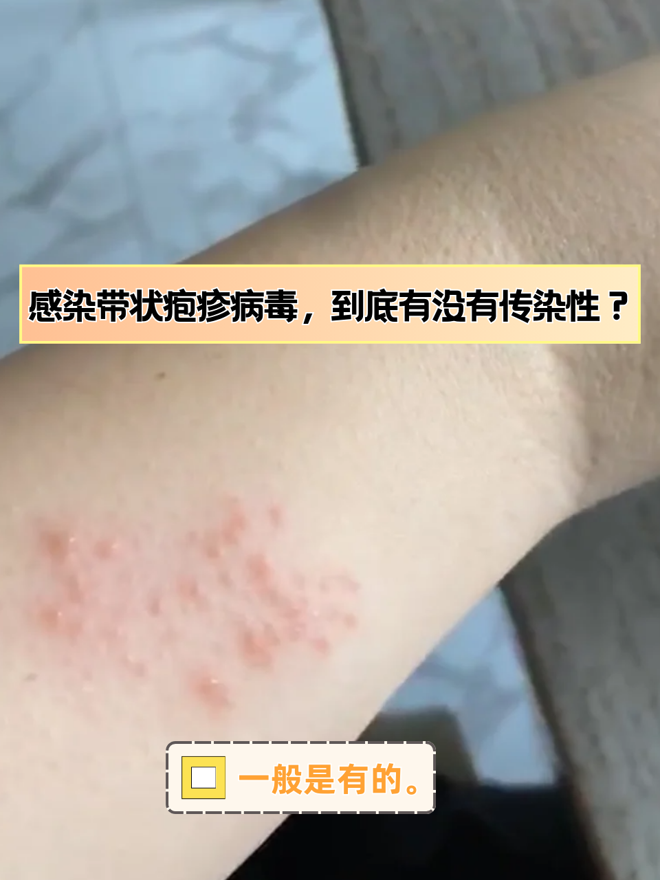 感染带状疱疹病毒,到底有没有传染性?