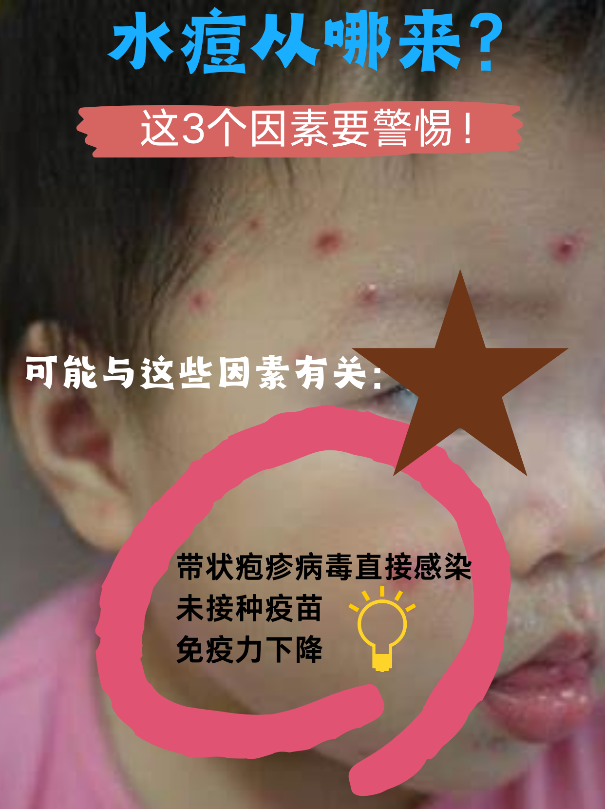 为什么得水痘 为什么得水痘