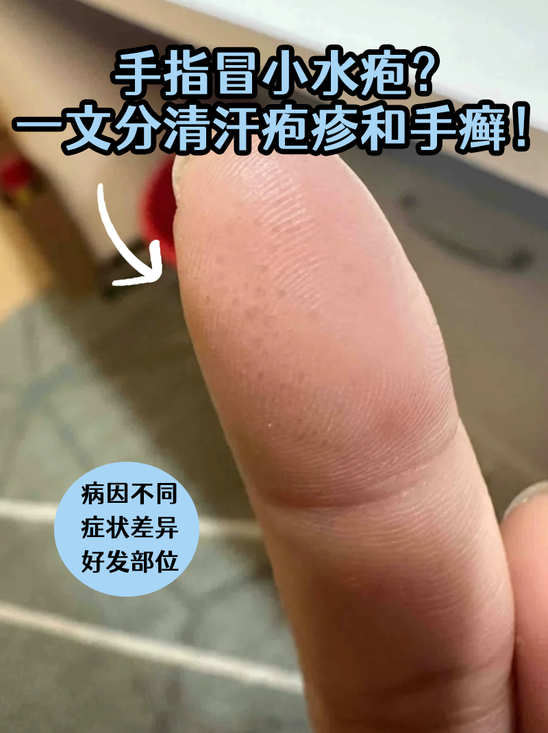 核心区别 病因不同 汗疱疹属于湿疹类,与过敏,精神压