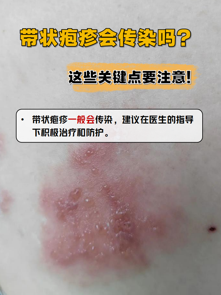 带状疱疹会传染吗?这些关键点要注意!