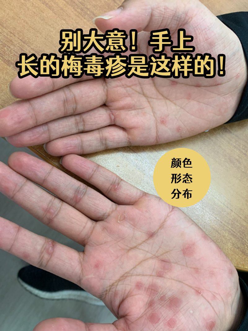 手上长的梅毒疹是这样的!