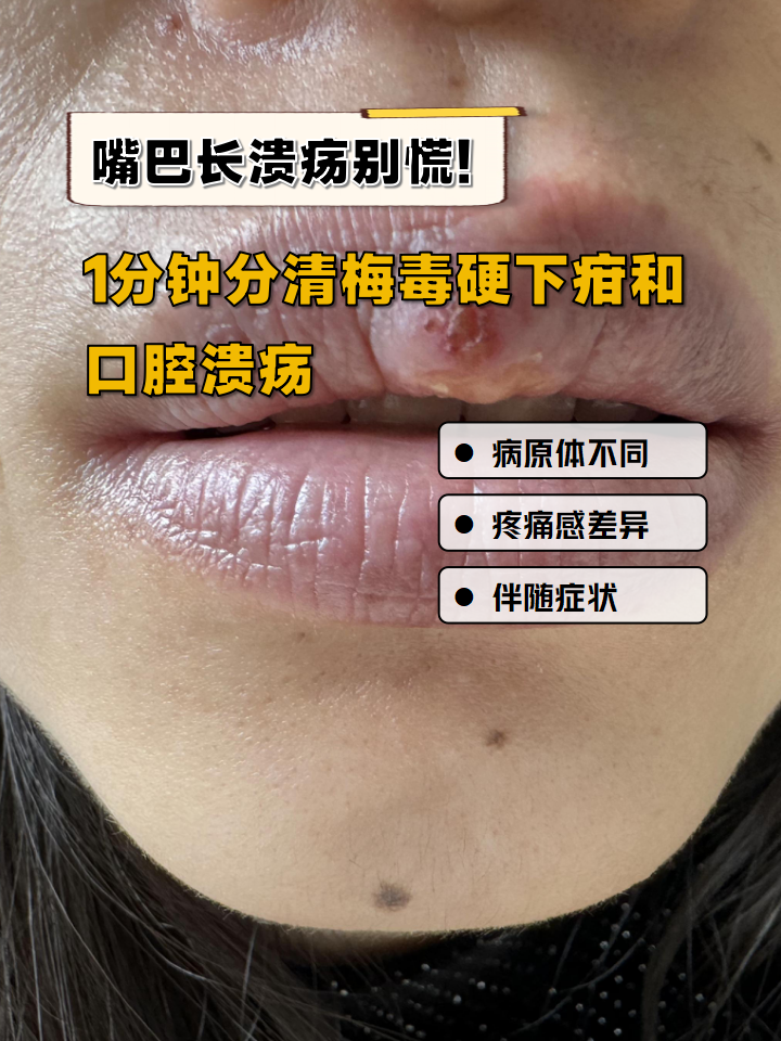 嘴巴长溃疡别慌!