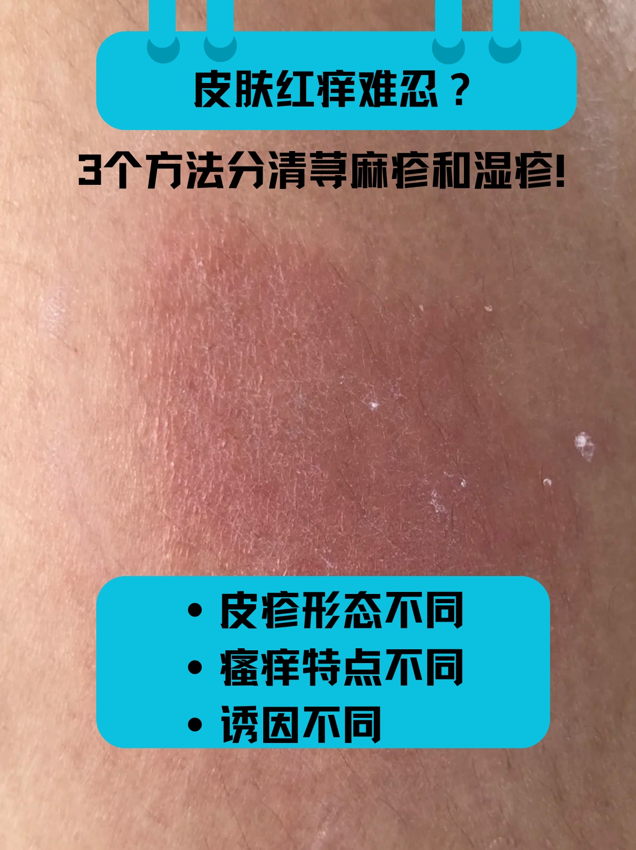 为什么天气热皮肤就痒 为什么天气热皮肤就痒