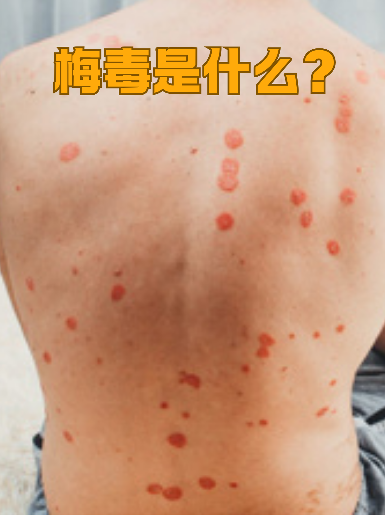 梅毒的典型症状 一期梅毒 二