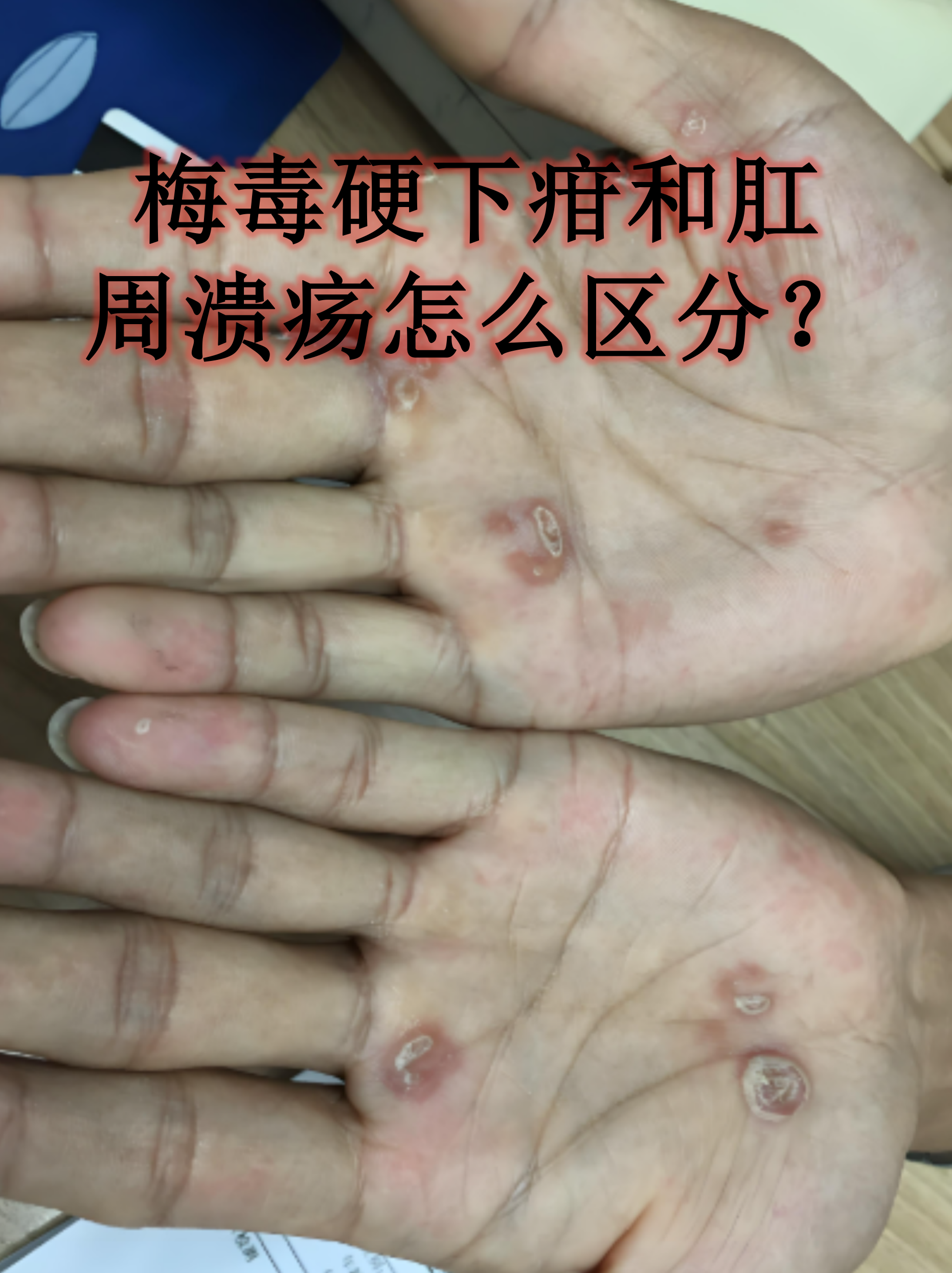 梅毒硬下疳和肛周溃疡虽然都可能出现在会阴区域,但两者的特征和