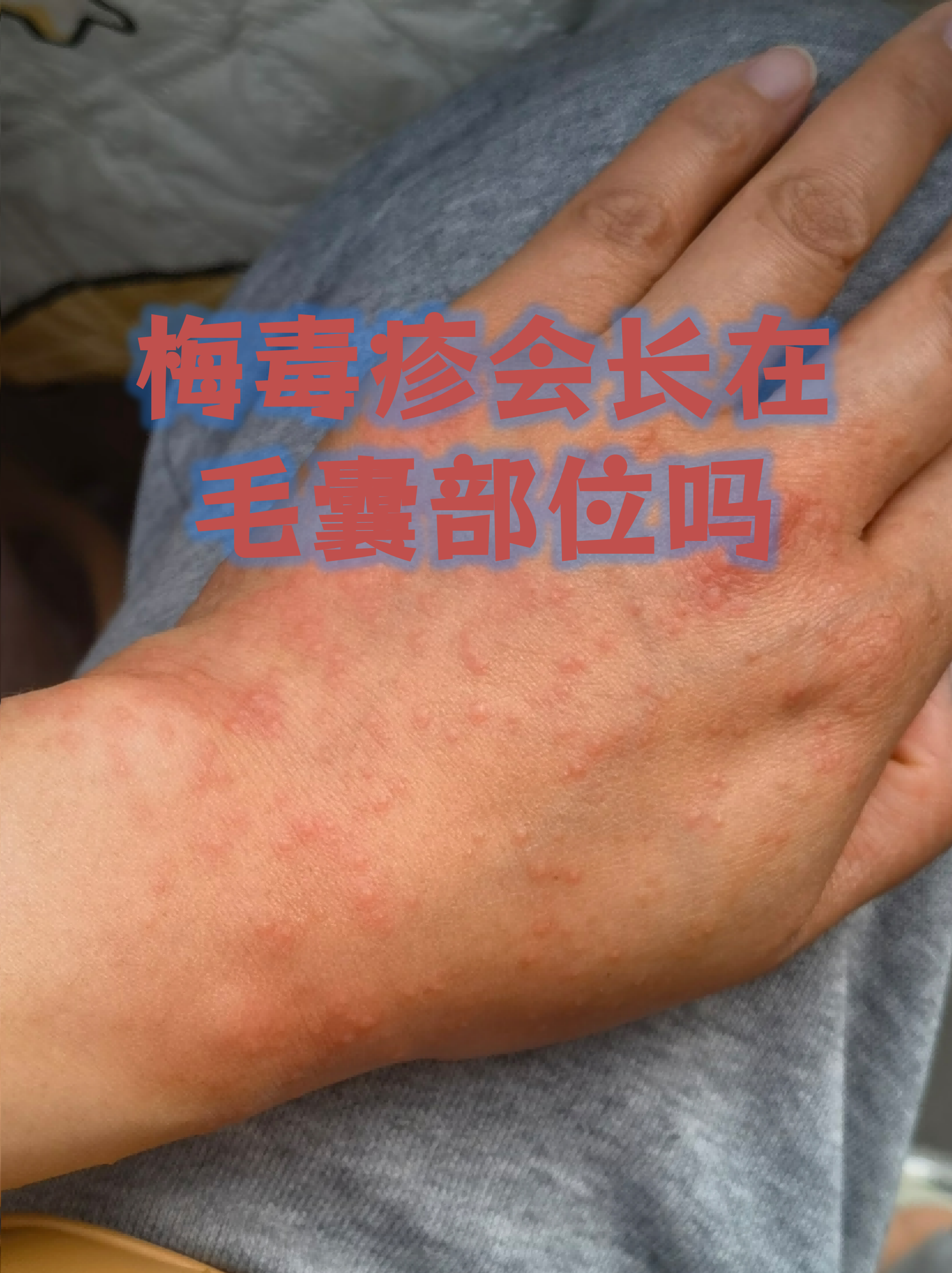 梅毒疹作为二期梅毒的典型症状,具有多样化的分布特点,掌握其特征有助