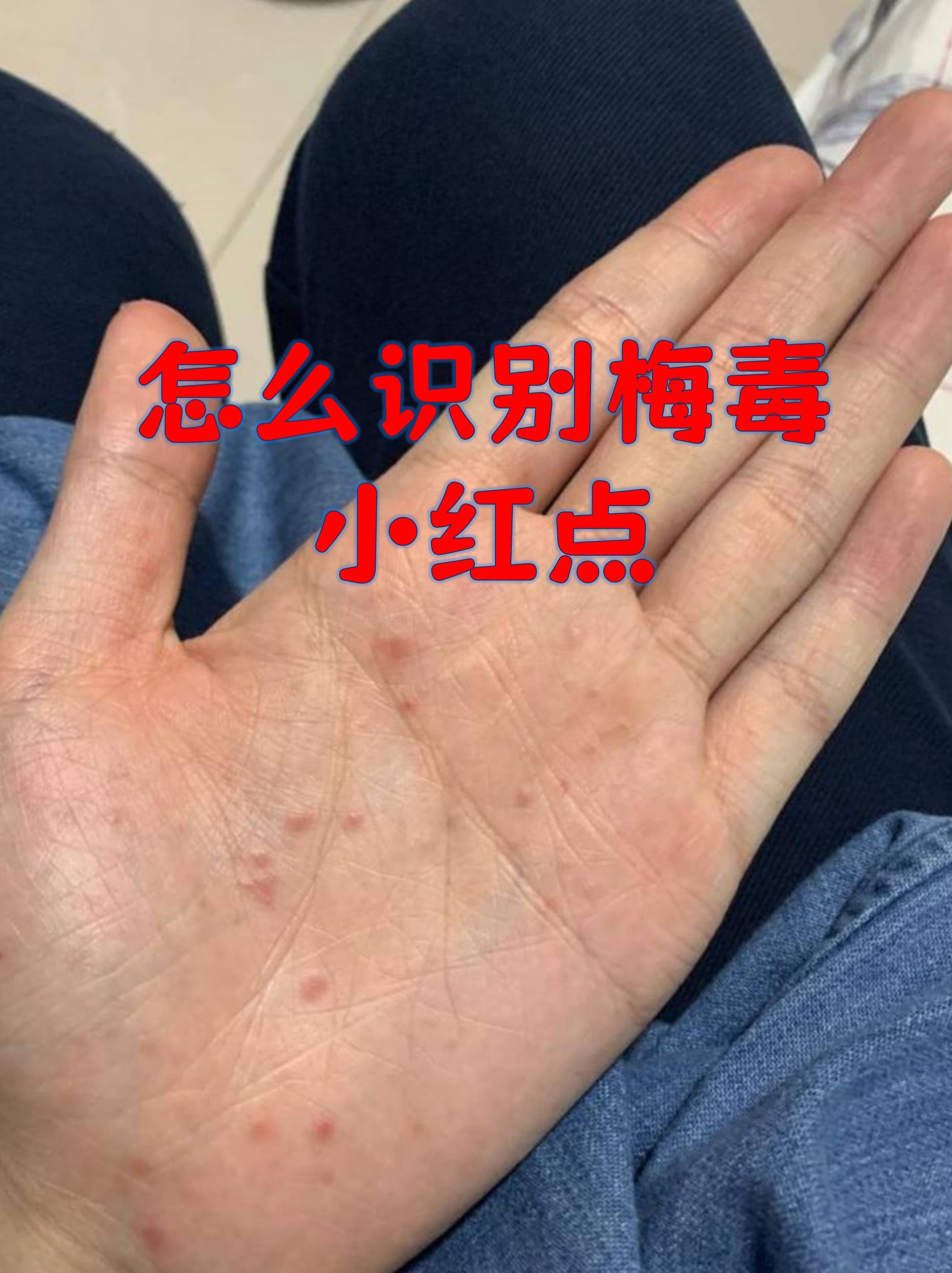 梅毒的红疹常被误认为是普通皮肤问题,但它的