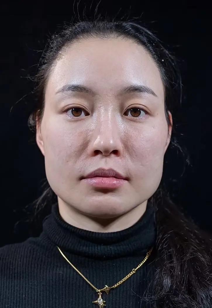 40岁宝妈,儿子都14岁了,刚做完去馒提升,说点大实