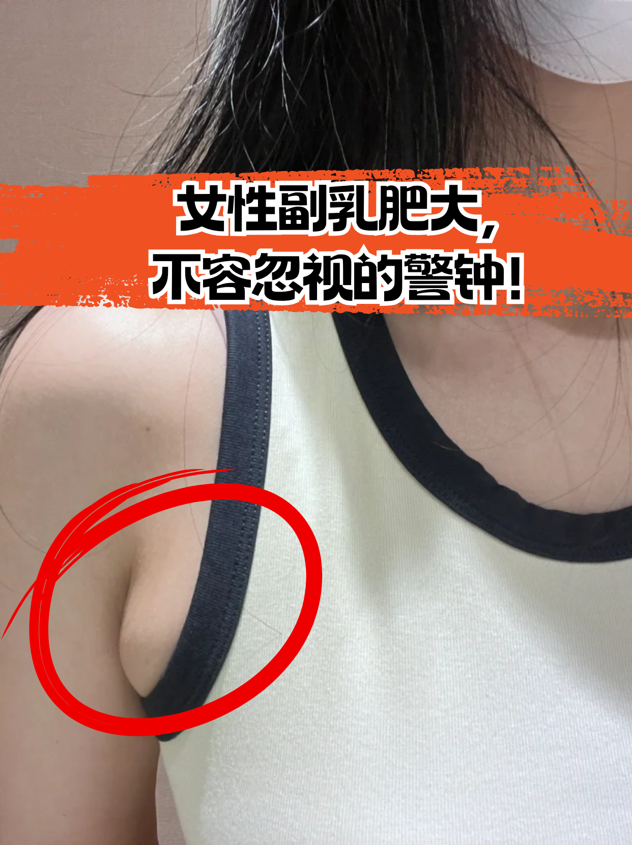 女性副乳肥大,不容忽视的警钟!