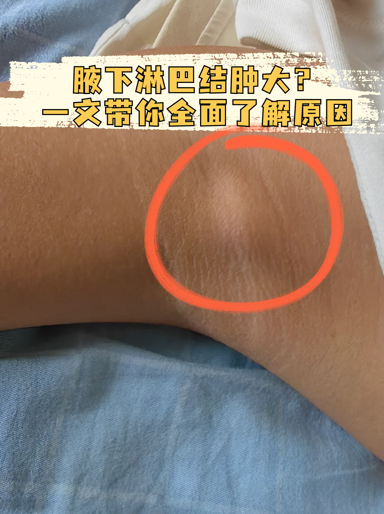 女性腋下淋巴堵塞图片图片