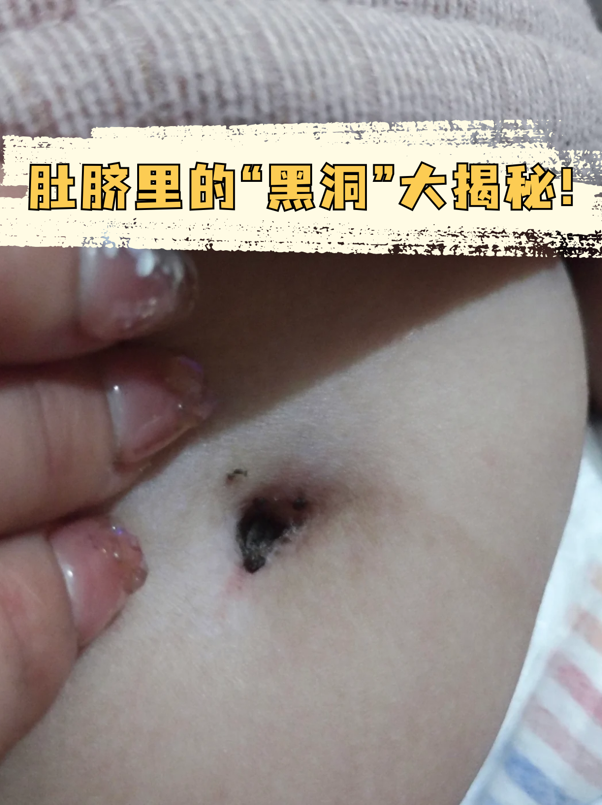 我们有时候会看到肚脐眼深处黑黑的,还有一股异味,闻起来臭臭的