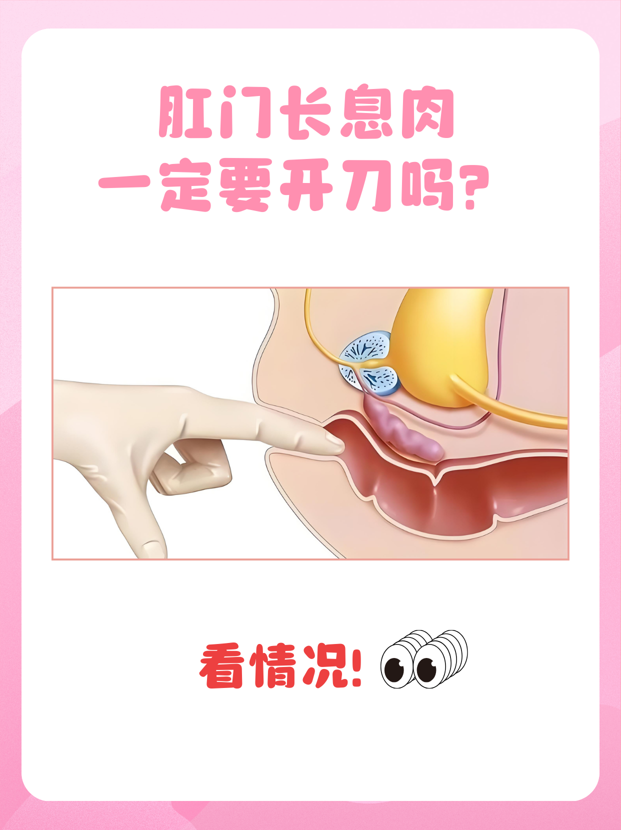 别慌,今天就来详细说说肛门息肉到底是不是一定要开刀