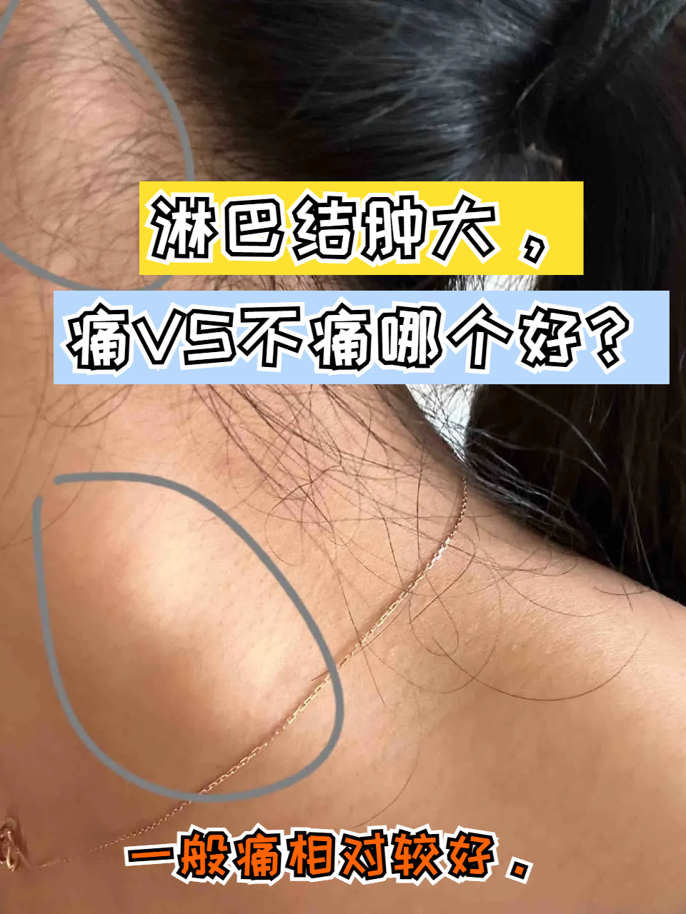 生活中很多人会出现淋巴结肿大的问题,有的人可能会出现明显的痛感,有