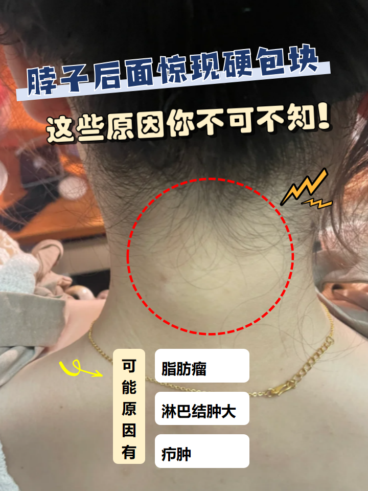 也可能是皮肤炎症引起的疖肿,还有可能是淋巴结肿大