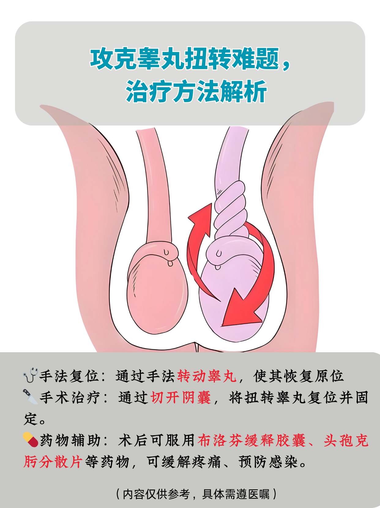 睾丸扭转的常见治疗方法: 手法复位:在发病初期,医生通过轻柔手