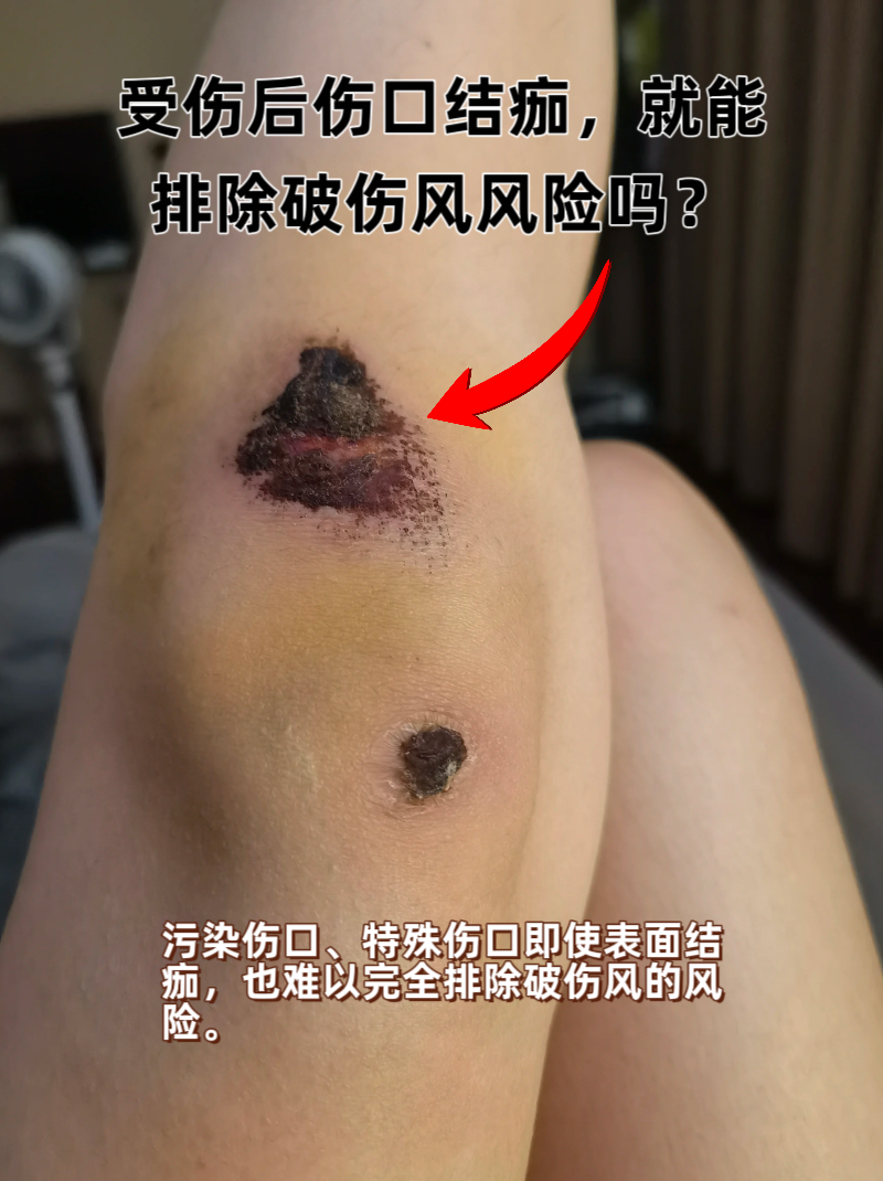 受伤后伤口结痂,就能排除破伤风风险吗? 污染伤口,特殊伤