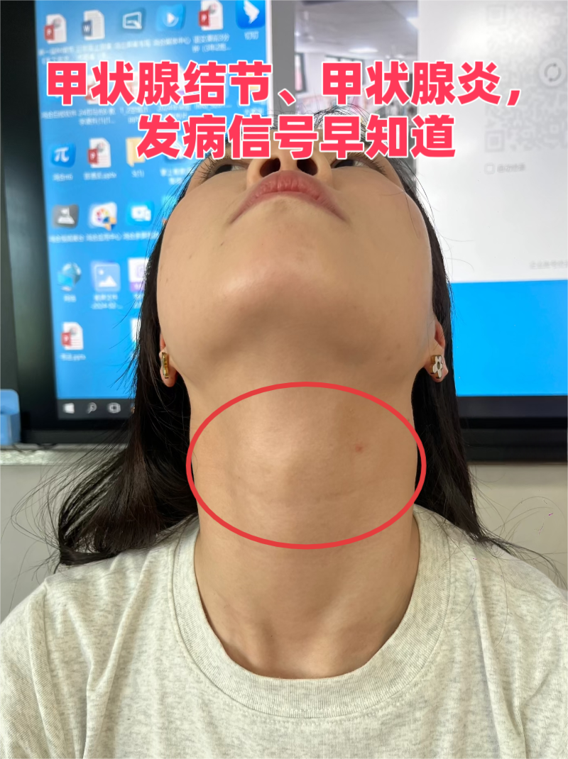 甲状腺结节和甲状腺炎悄悄找上门时,身体会提前发出预警