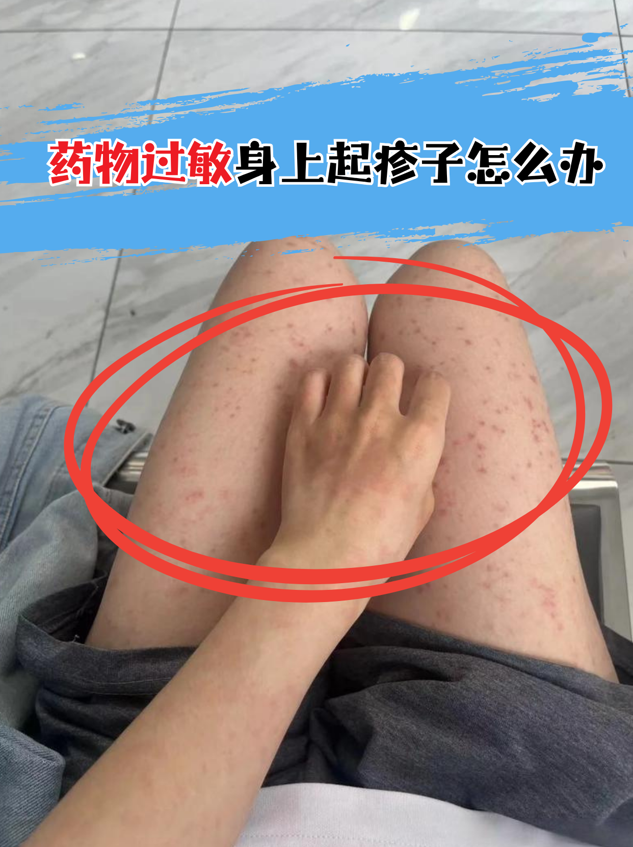 药物过敏的典型表现 皮肤红疹:多呈对称分布,伴随瘙痒或灼热感,雏见