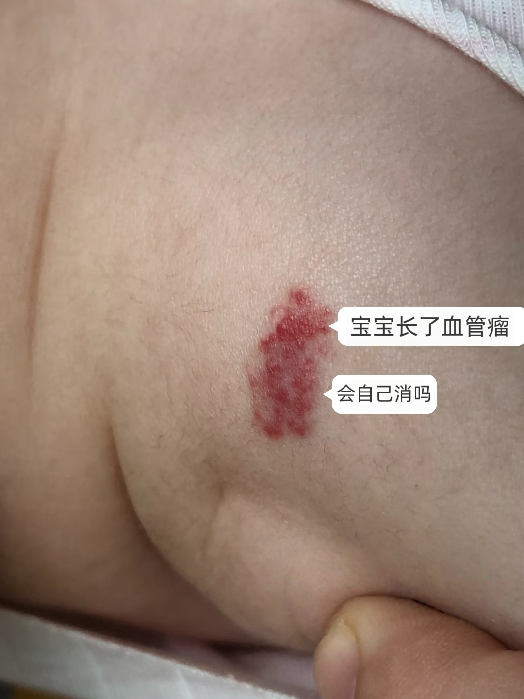 多数血管瘤不会自己消失,就算退,消退时间,退到啥程度都是未知数