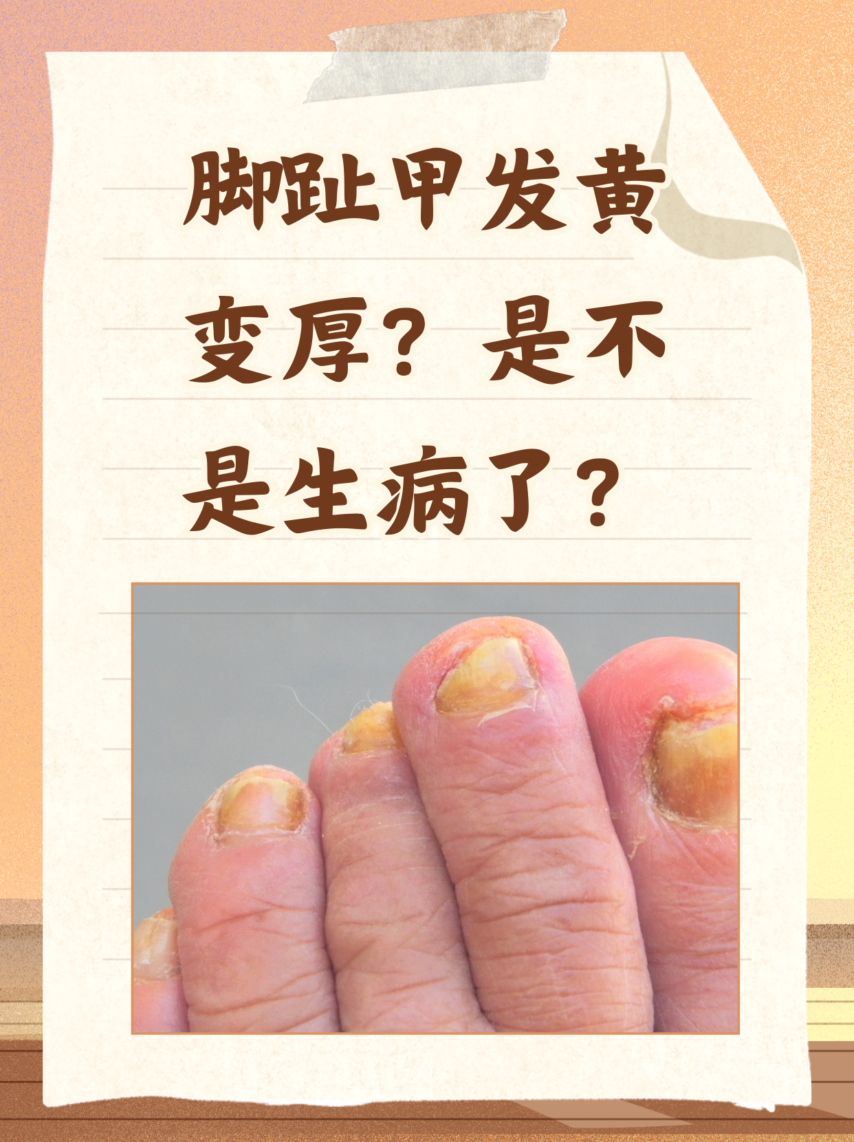 盖发黄变厚怎么回事指甲厚硬黄萎缩是怎么回事指甲发黄し艨 脚趾甲